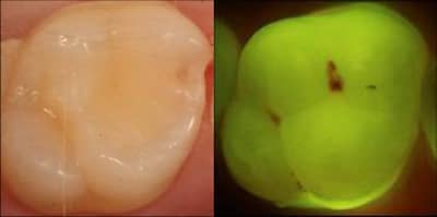 Fissure caries