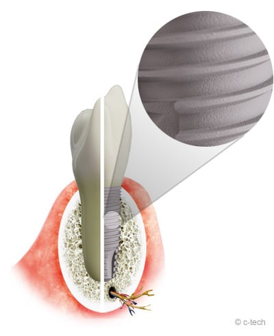 Implants dentaires - doux - précis